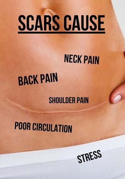 Scar Tissue Release Therapy