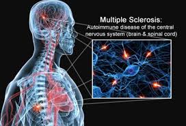 Bowen Therapy Multiple Sclerosis Pain Treatment Collingwood