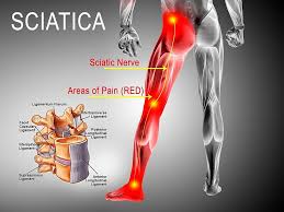 Bowen Therapy Sciatica Pain Relief Treatment Collingwood