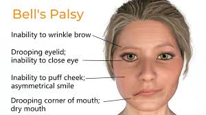 Bowen Therapy Bell's Palsy Relief Treatment Collingwood