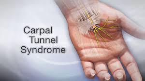 Bowen Therapy Carpal Tunnel Syndrome Pain Relief Treatment Collingwood, On